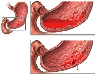 Gis Kanama Belirtileri ve Tedavisi
