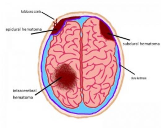 Beyin Kanamas Sonular