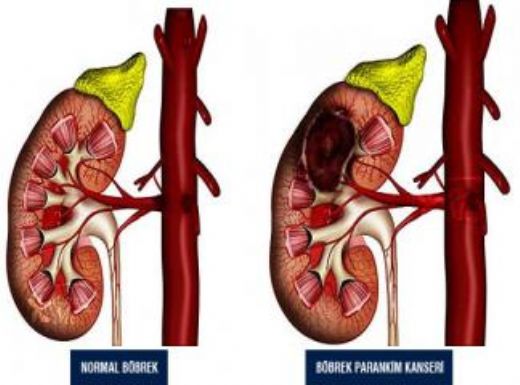 Böbrek Kanaması Belirtileri ve Tedavisi