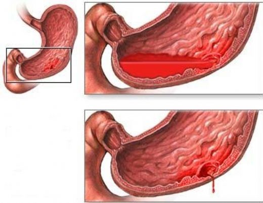 Gis Kanama Belirtileri ve Tedavisi