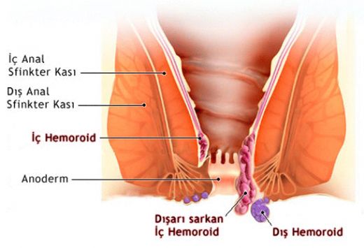 İç Hemoroid Kanaması Belirtileri ve Tedavisi