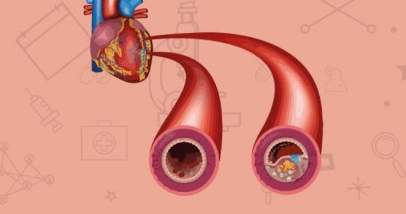 Atardamar Kanaması Belirtileri ve Tedavisi