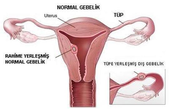 D Gebelikte Kanama