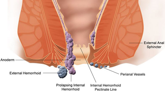 Hemoroid Kanaması