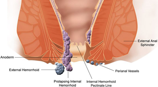 Hemoroid Kanamas